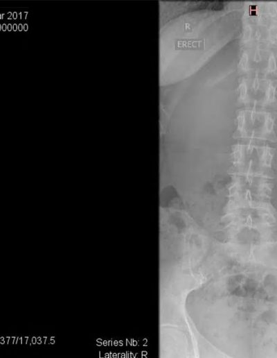 Liezl After MCS TREATMENT
